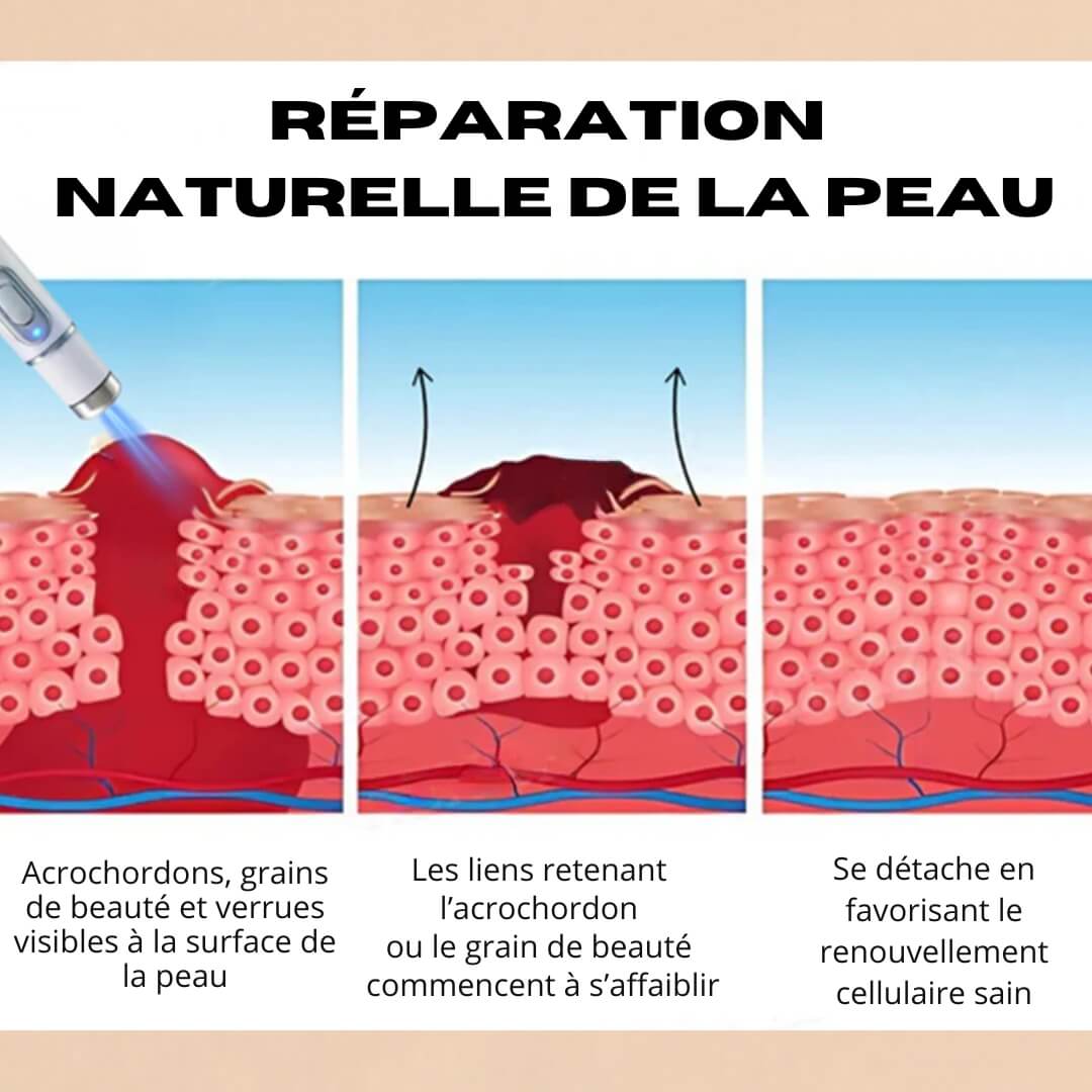 Stylo Laser Kidsneed® non-invasif – Élimine Verrues, Grains de Beauté, Tâches & Imperfections