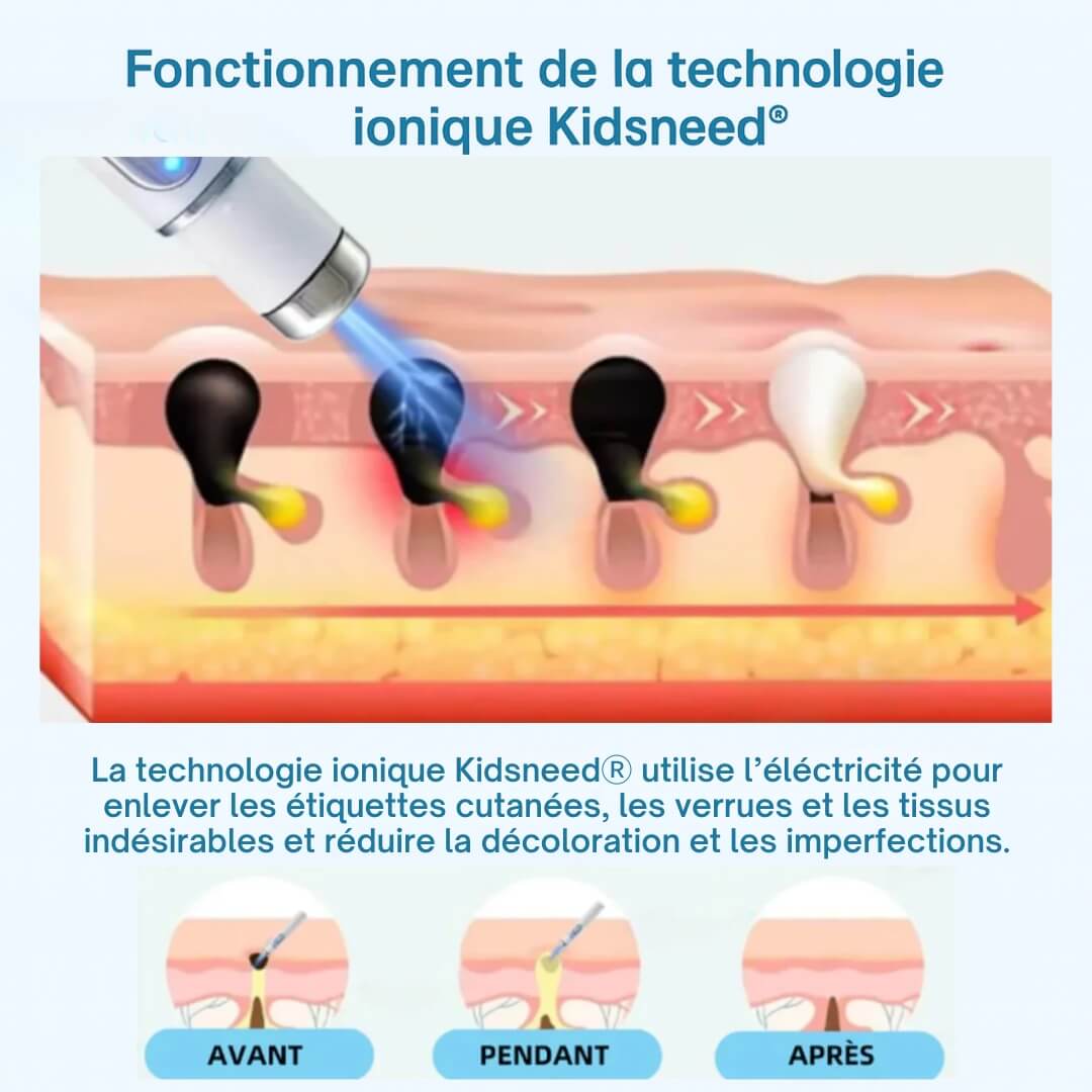 Stylo Laser Kidsneed® non-invasif – Élimine Verrues, Grains de Beauté, Tâches & Imperfections